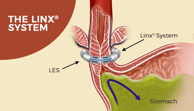 How is the LINX procedure performed?