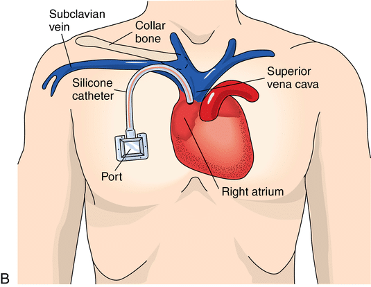 ¿Qué es un Mediport (Port-a-Cath)?