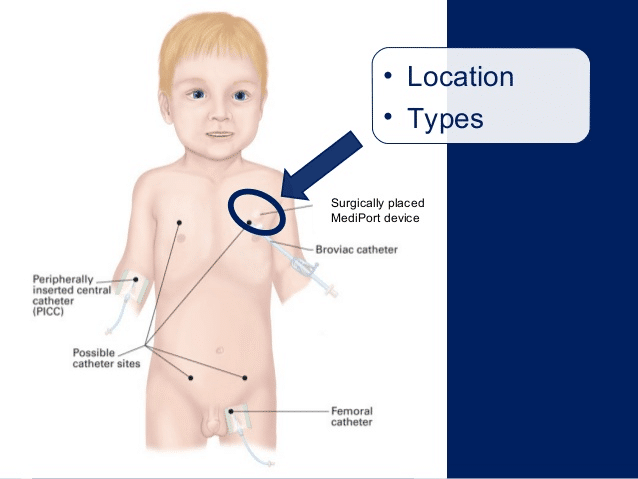 Los puertos implantados se pueden utilizar para: