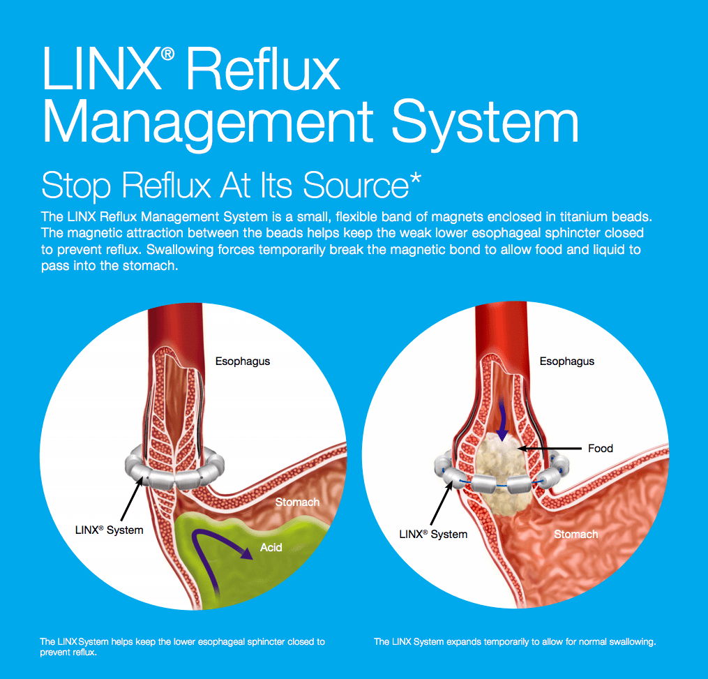Procedimiento LINX