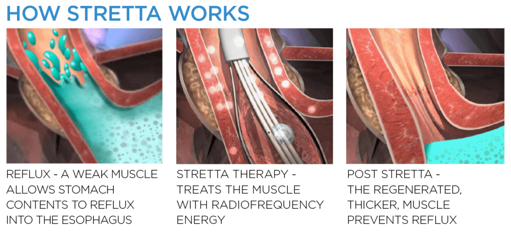 How Is the Stretta procedure Performed?