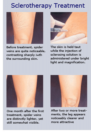 Escleroterapia y Flebectomía