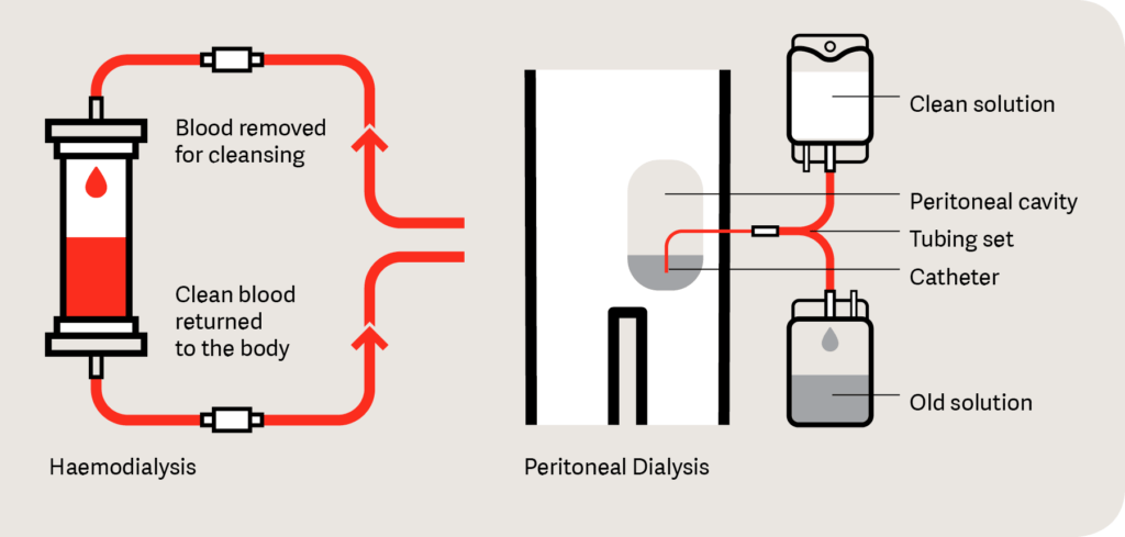 ¿Cuál es la ventaja de la diálisis peritoneal sobre la hemodiálisis?