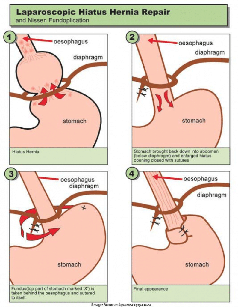 Fundoplicatura Laparoscópica Y Reparación De Hernia Hiatal