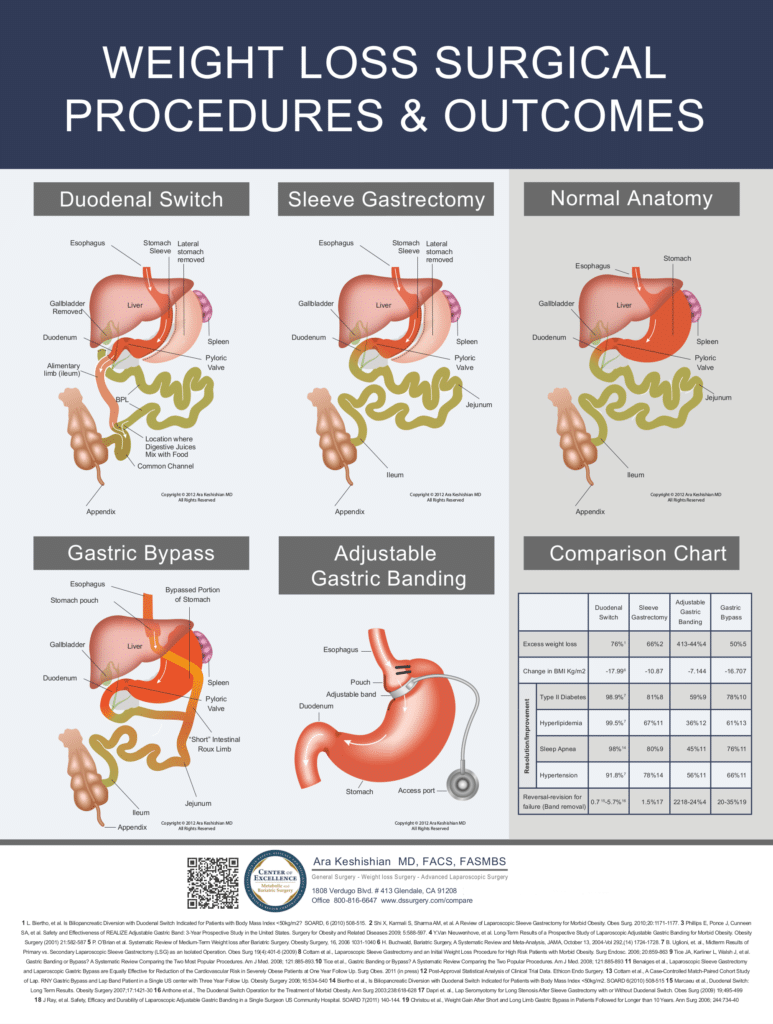 Interruptor Duodenal Laparoscópico (LDS)