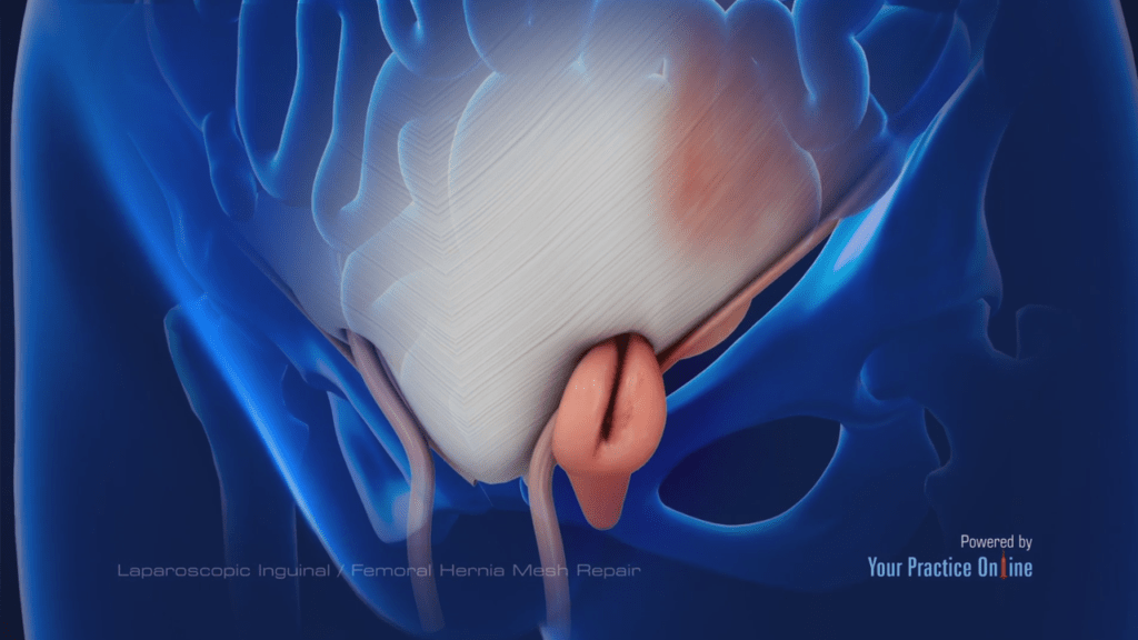 Reparación Laparoscópica de Hernia Inguinal