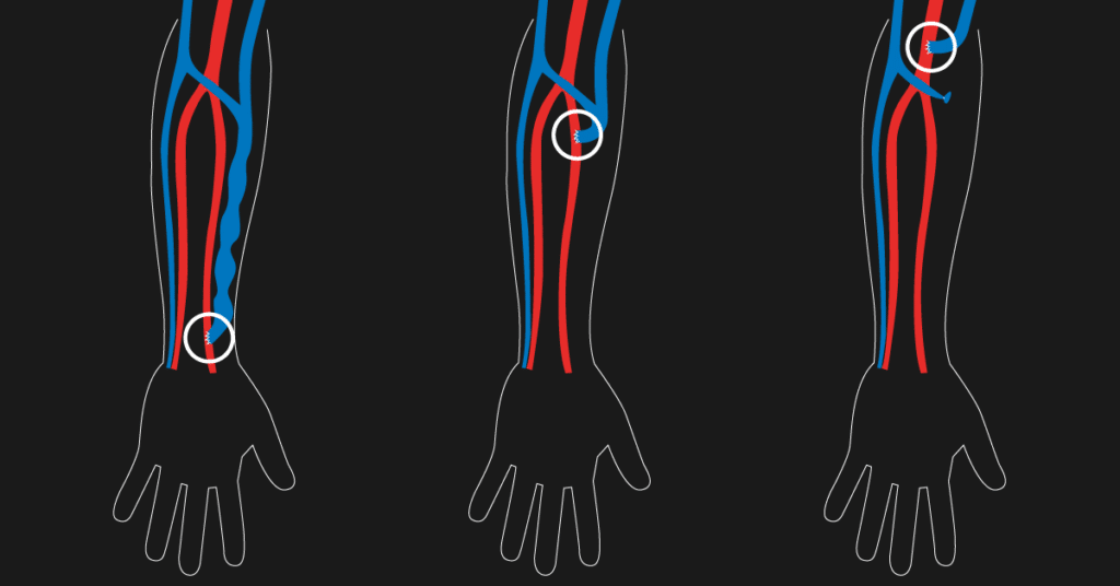 Angioplastia de Fistula Arteriovenosa y Stenting