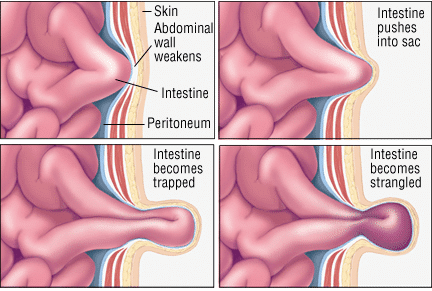 Reparación Laparoscópica de Hernia Ventral