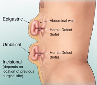 hernia ventral