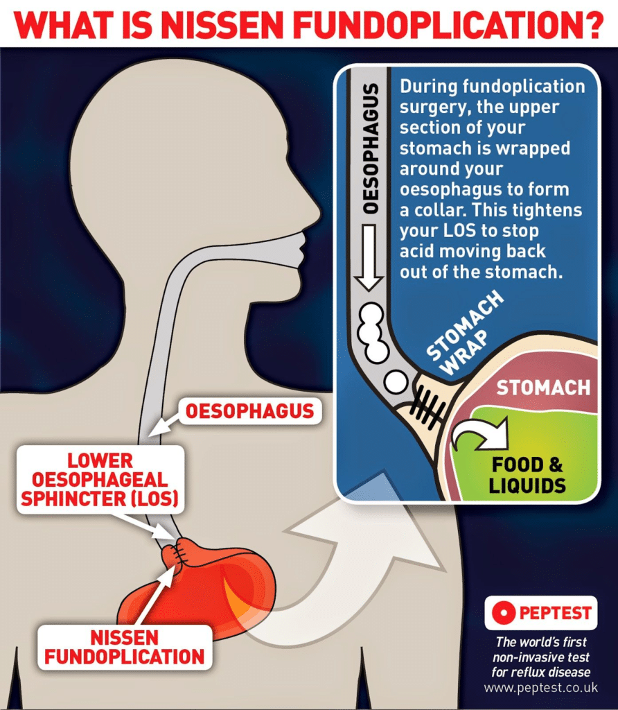 Fundoplicatura Laparoscópica Y Reparación De Hernia Hiatal