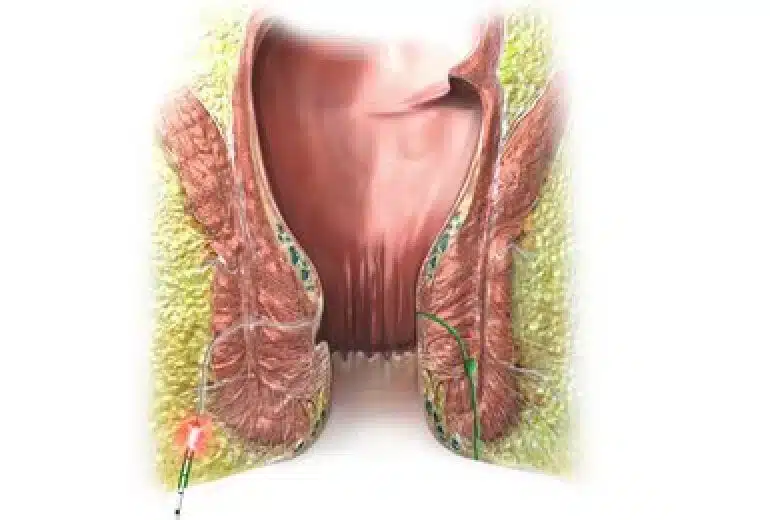 Fístulas anales FiLaC®