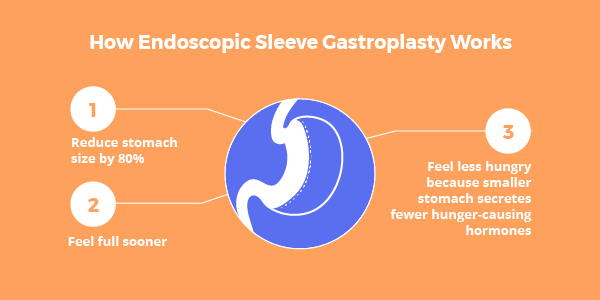 Endoscopic Sleeve Gastroplasty (ESG)