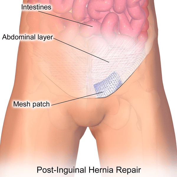 Image Of Post-inguinal Hernia Repair
