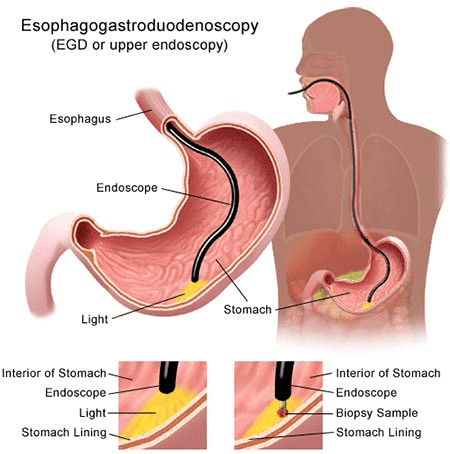 Booklet: Esophagastroduodenoscopy (EGD or upper endoscopy)