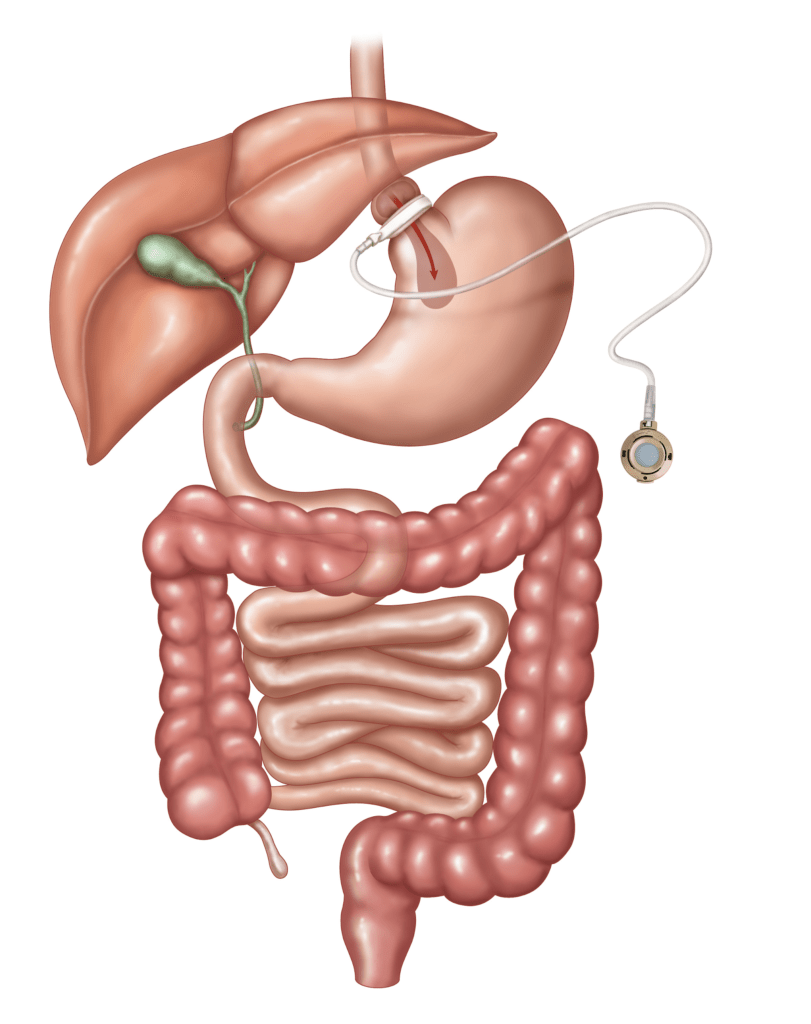 Laparoscopic Adjustable Gastric Band