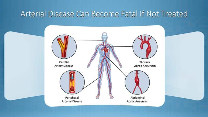Booklet: Arterial Disease Can Become Fatal If Not Treated
