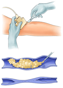 Illustration Of Sclerotherapy & Phlebectomy Procedure