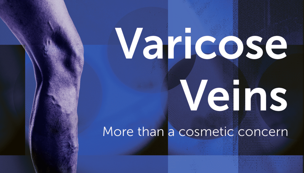 Image of Varicose Veins