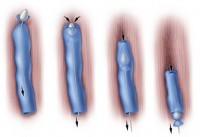 Illustration Of Veins In Need Of Vein Stripping Procedure