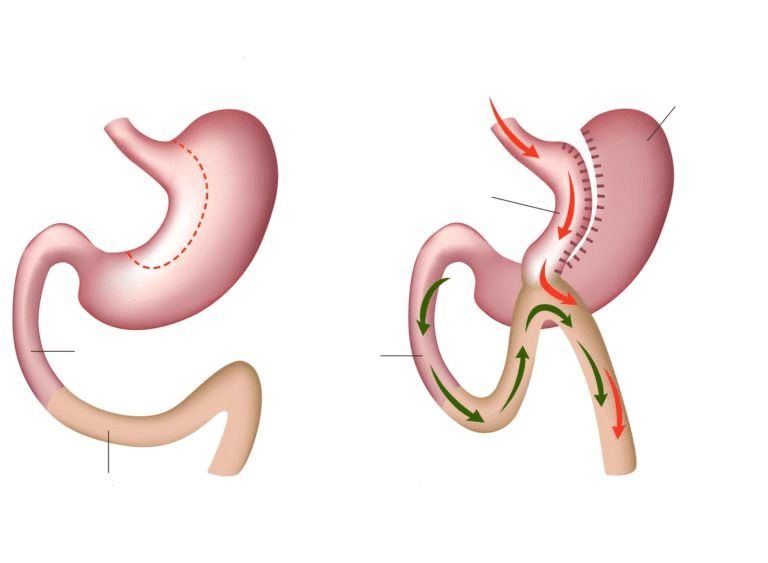 Bypass Mini-Gástrico Laparoscópico (OAGB)