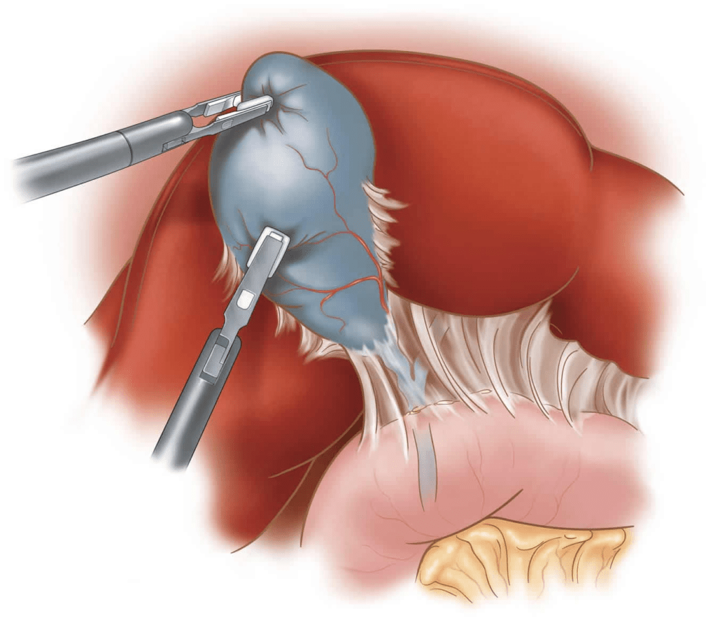 Illustration Of Single Incision Gallbladder Surgery