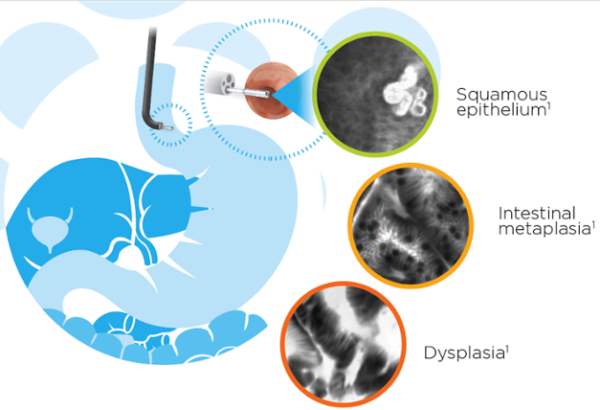 Cellvizio®: Advanced Diagnostic Tool For Chronic Acid Reflux