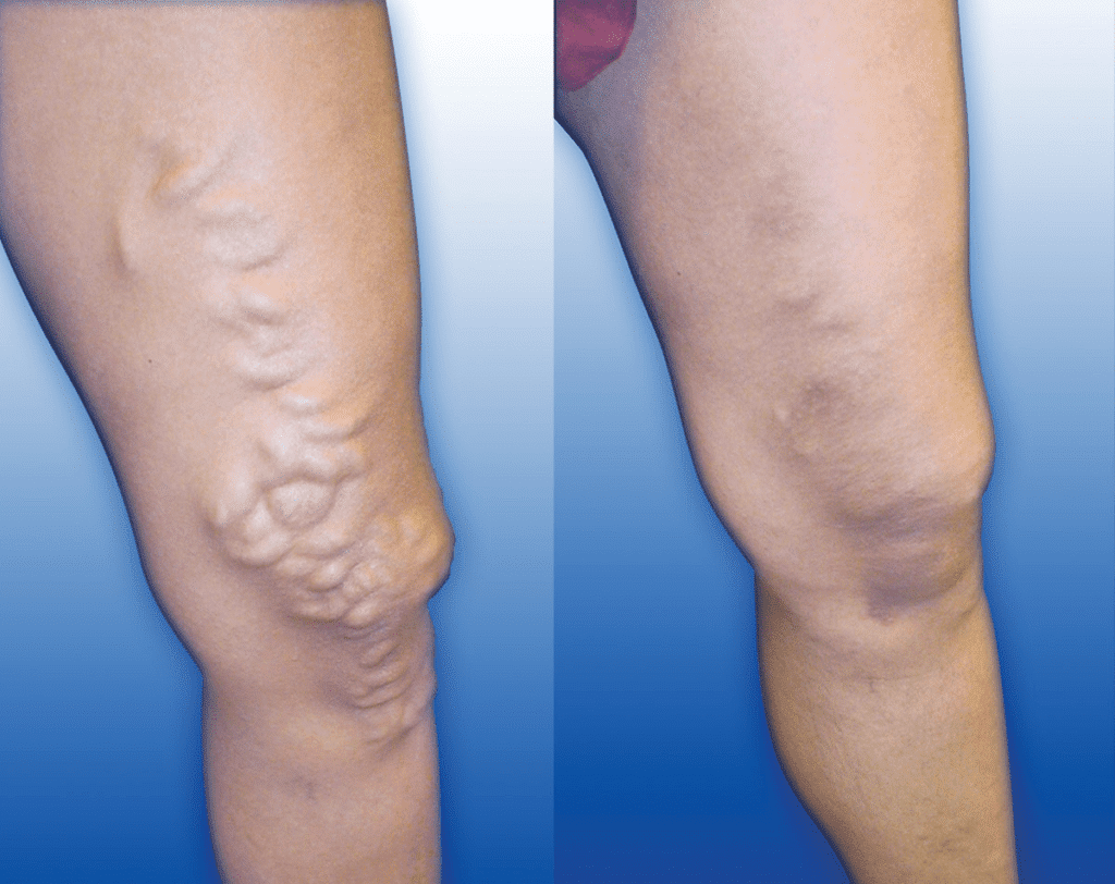 Image Before And After The Venacure EVLT Procedure