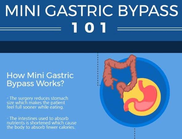 Booklet: Mini Gastric Bypass