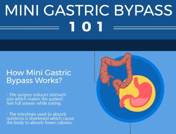 Bypass Mini-Gástrico Laparoscópico (OAGB)