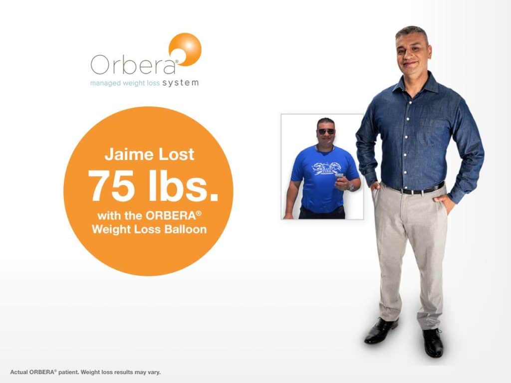 Image Of A Man Who Lost Weight With The ORBERA Weight Loss Balloon