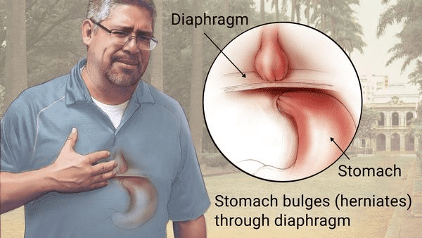 Image Of A Man With A Hernia Of The Esophageal Orifice Of The Diaphragm