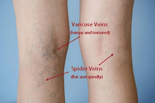 Image Of Varicose And Spider Veins