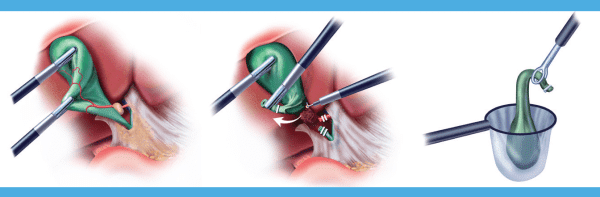 Illustration Of The Gallbladder Removal Procedure