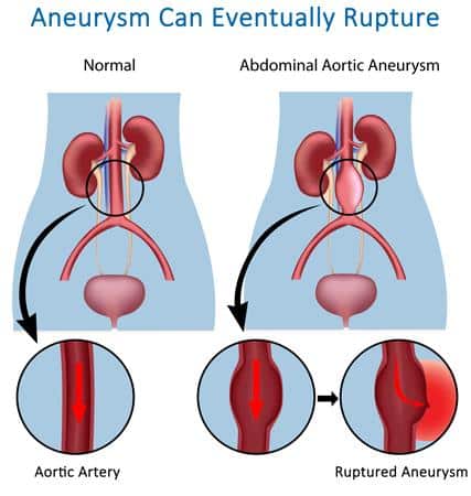 Booklet: Aneurysm Can Eventually Rupture