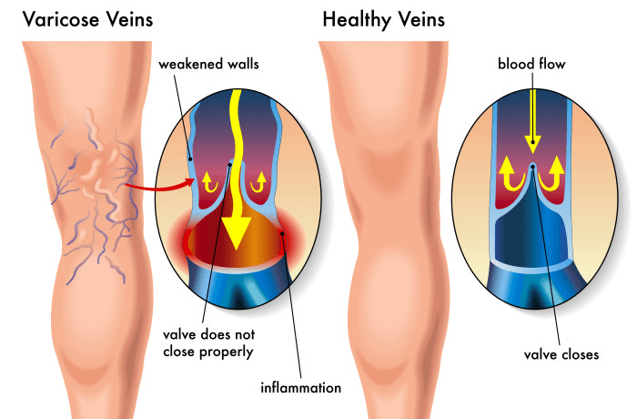 Illustration Of Varicose And Healthy Veins