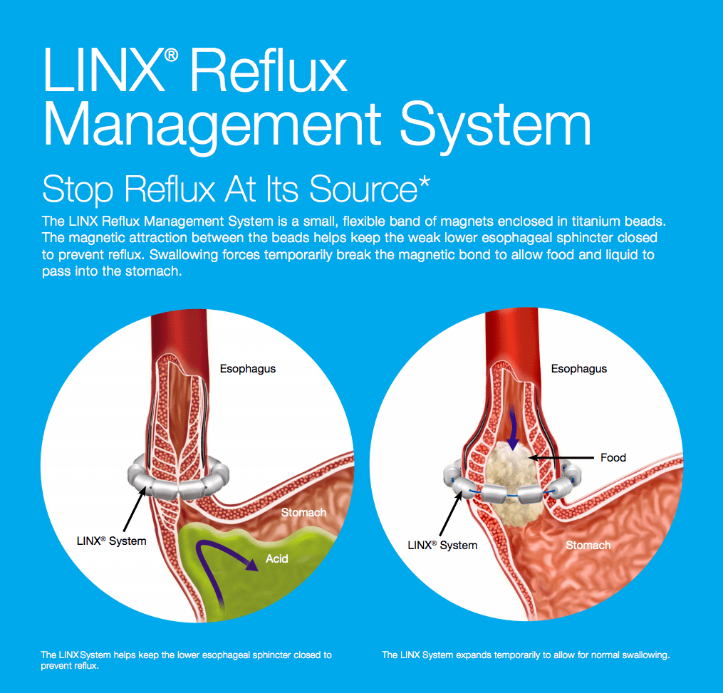 Linx Reflux Management System
