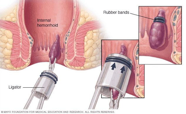 Illustration Of Hemorrhoid Banding Or Ligation (CPT 46250)