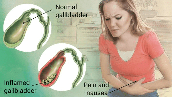 Illustration Candidate For Laparoscopic Gallbladder Removal