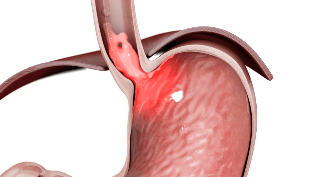 Single anastomosis sleeve ileal bypass