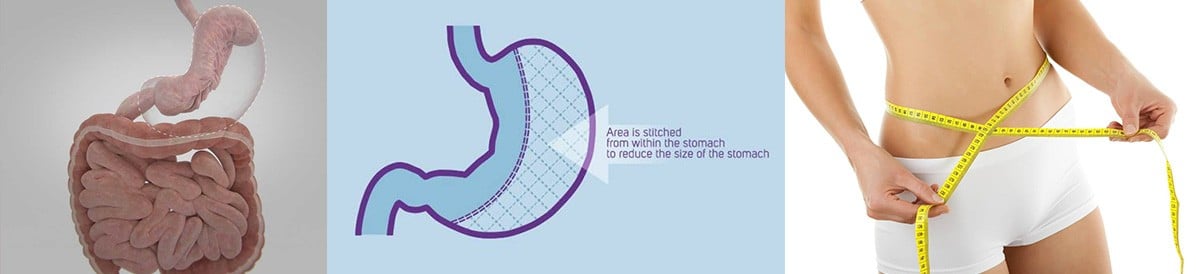 ENDOSCOPIC SLEEVE GASTROPLASTY CAN LEAD TO SIGNIFICANT WEIGHT LOSS!