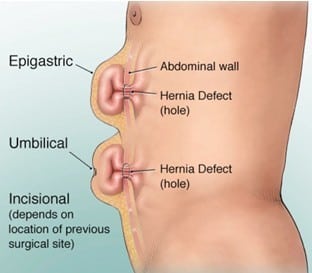 Image Of Ventral Hernia With Explanation