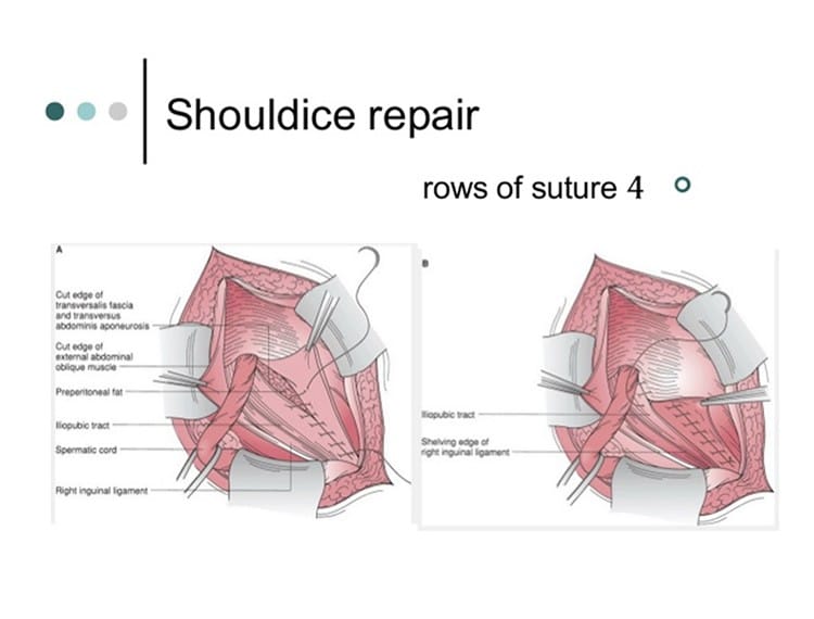 Illustration: Shouldice repair