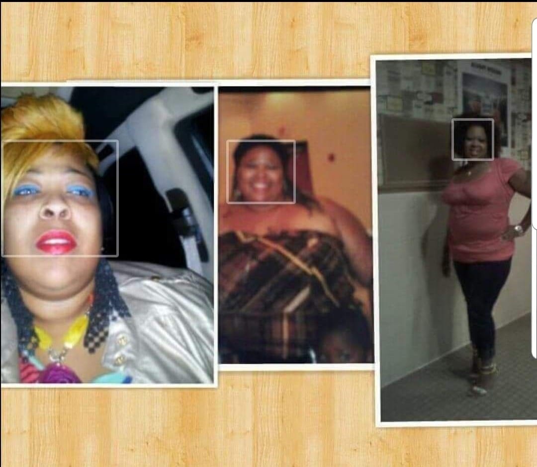 Photos of the patient before and after weight loss