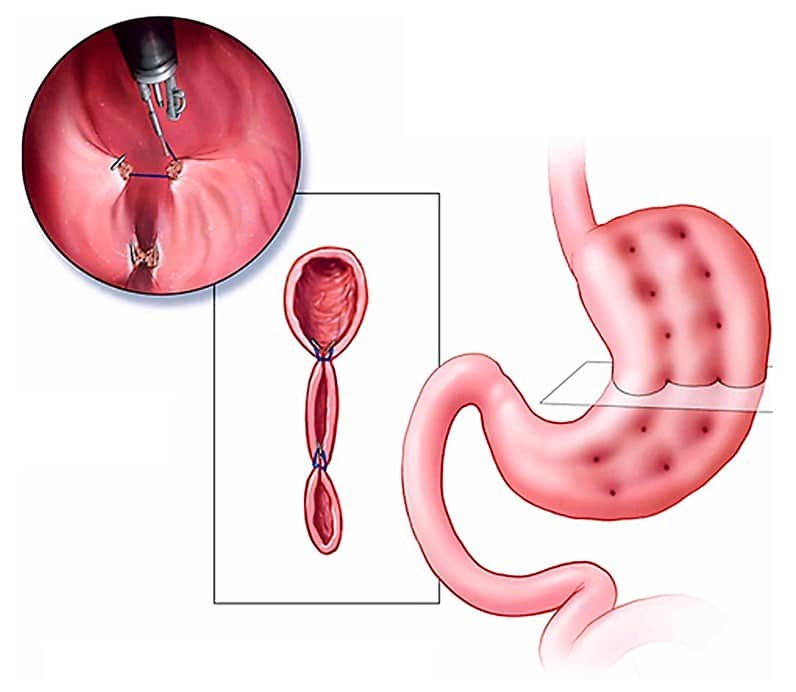 Endoscopic Bypass