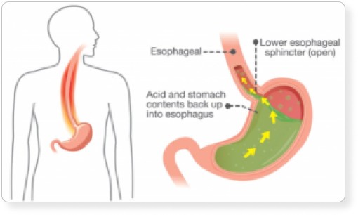 Acid Reflux