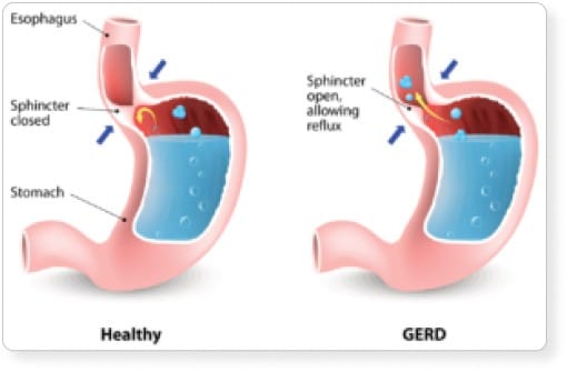 Image of Healthy and GERD Stomach