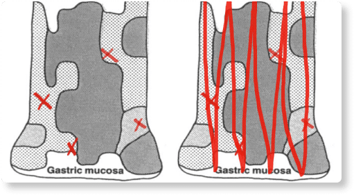 Biopsia de WATS en 3D