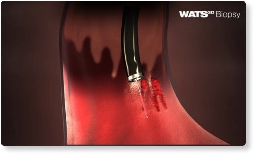 Biopsia de WATS en 3D