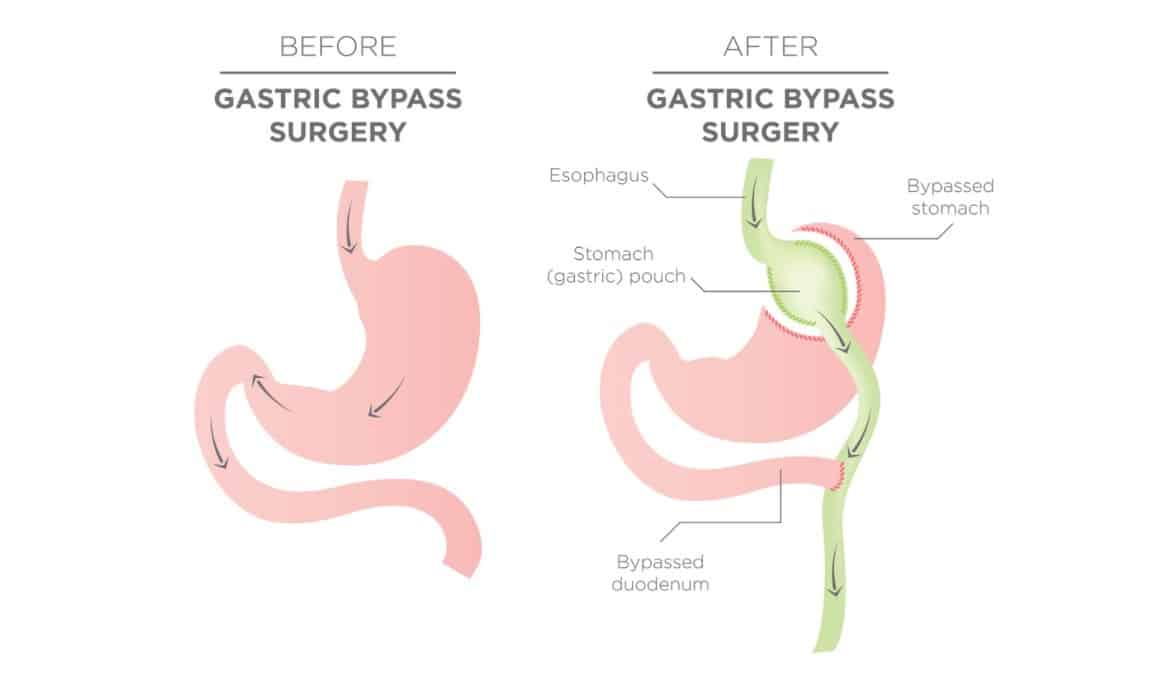 Illustration: Before And After Gastric Bypass