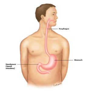 Illustration Achalasia